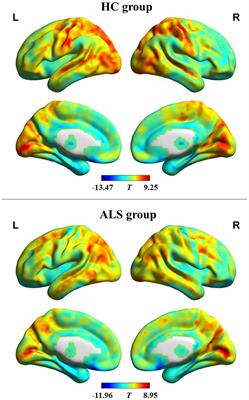 Dynamic Alterations in Functional Connectivity Density in Amyotrophic Lateral Sclerosis: A Resting-State Functional Magnetic Resonance Imaging Study